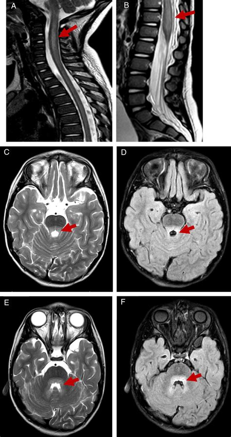 T2 Weighted And Flair Mr Images Showing Hindbrain Involvement With