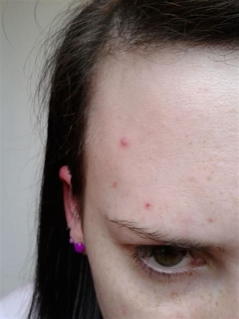 My Roaccutane Journey How My Acne Affects My Self Esteem And What Products I Use Pre Roaccutane