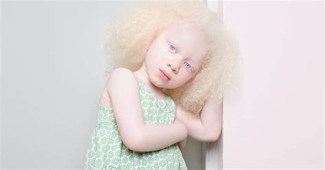 Porträtfotos Von Menschen Mit Albinismus