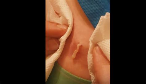 Draining A Massive Cyst On The Back New Pimple Popping