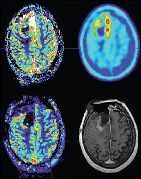 Fluorescence Guided Surgery Intraoperative Imaging And Brain Mapping