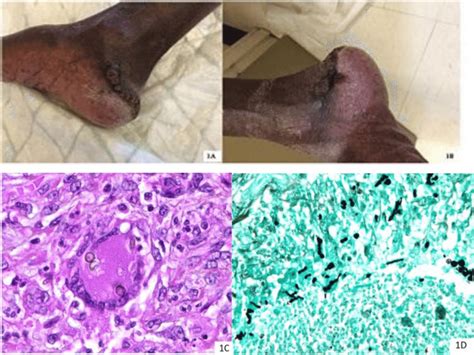 Painless Nodules With Superficial Ulceration 1a And 1b 1c And 1d