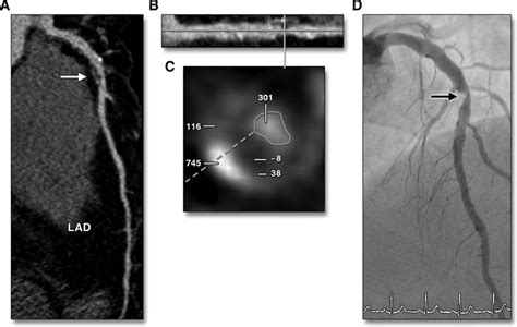 Fractional Flow Reserve And Coronary Computed Tomographic Angiography