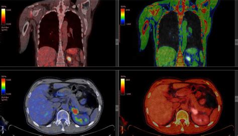 Understanding Your Fdg Pet Scan