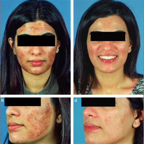 Pdf Postinflammatory Hyperpigmentation In An Asian Patient A