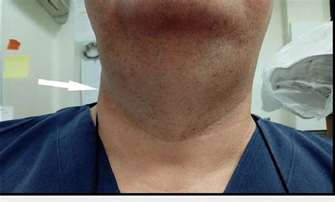 Arrow Shows Mildly Swollen Neck With Moderate Urticaria No Signs Of