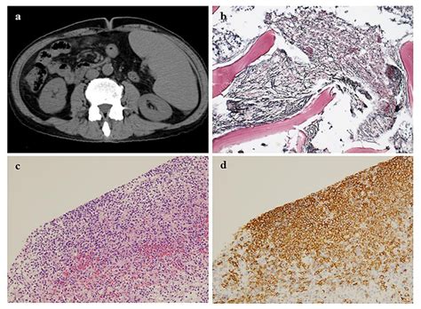 Figure 1 From Splenic Marginal Zone Lymphoma With Prominent