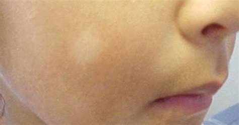 7 Super Easy Ways To Remove White Patches On Baby Face