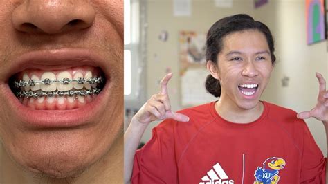 My Biggest Insecurity 😰😬 Why I Got Braces Twice Experience With Adult Braces Retainers