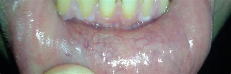 White Gums A Sign Of Oral Std Rstd