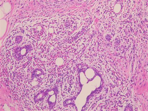 Histopathology ×10 Reveals Dense Periductal Mixed Inflammatory Cell