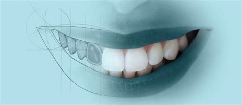 Everything You Need To Know About Porcelain And Composite Veneers