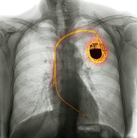 Dual Chamber Pacemaker Photograph By Science Photo Library Fine Art