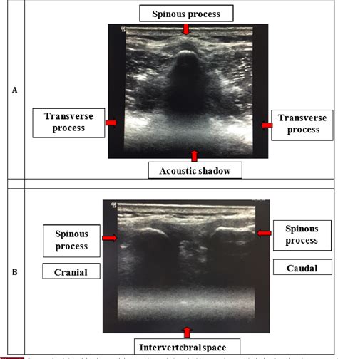 Figure From Comparing Ultrasonography And Surface Landmark Guided