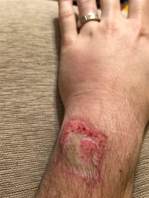 Man Shares Photos After Fitbit Fitness Tracker Exploded On His Wrist