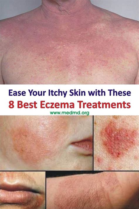 Eczema Skin Rashes Treatment