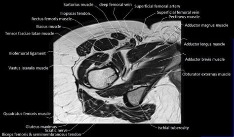 Mri Anatomy Of Hip Joint Free Mri Axial Hip Anatomy In 2021 Hip