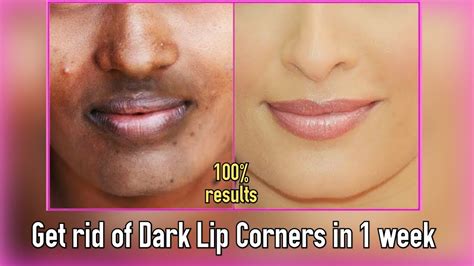 Why Are The Corners Of My Lips Dark