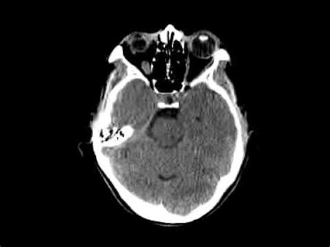 How can i tell if my dog or cat has a brain tumour? CT scans abnormal brain - YouTube