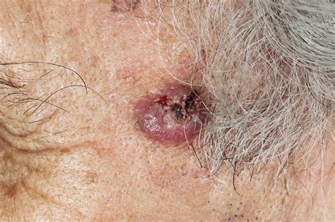Basal Cell Skin Cancer On The Face Stock Image C0110353 Science Photo Library