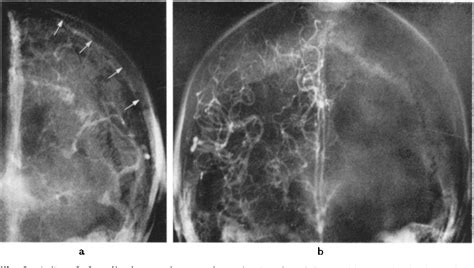 Figure 3 From Angiography In Senile Cerebral Atrophy Semantic Scholar