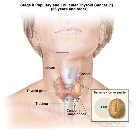 Can Papillary Thyroid Cancer Spread To Lymph Nodes Novisnet