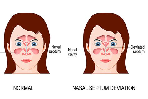 Deviated Septum In Children Penta Pediatric Ear Nose And Throat Of