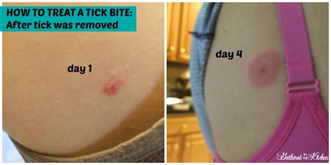 What To Do If You Get Bite By A Tick Tick Bite Treatment Easy Diy Home