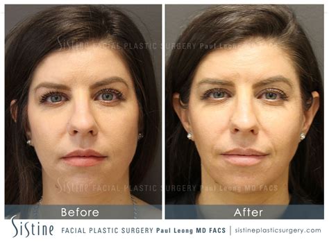 Masseter Before And After 02 Sistine Facial Plastic Surgery