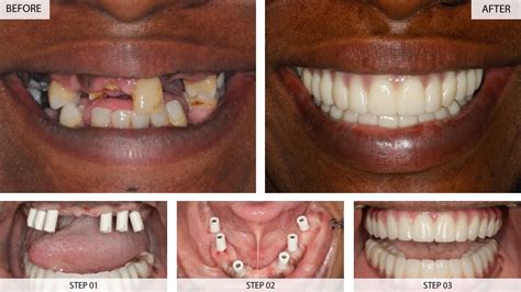 All On 4 Dental Implants Before And After