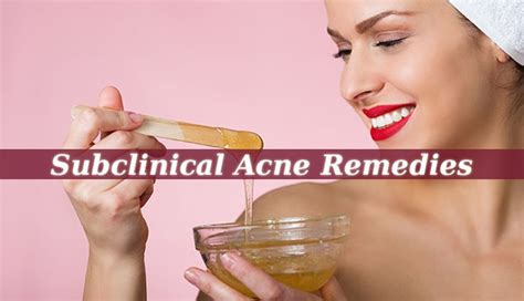 Subclinical Acne Is An Unpleasant Condition That Many People Struggle