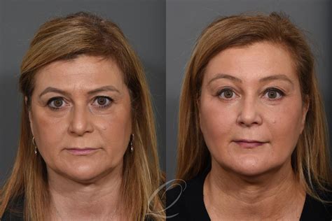 Brow Lift Before After Photos Patient 1273 Serving Rochester
