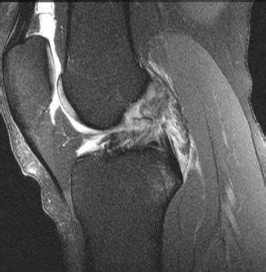 Meniscal Injury Knee Sports Orthobullets 1560 Hot Sex Picture