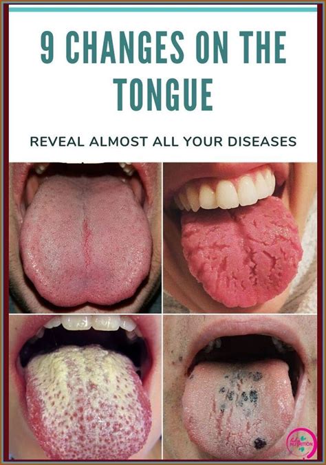 Be Aware Of This These 9 Changes On Your Tongue Reveal Almost All Your