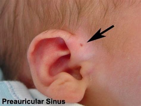 Pre Auricular Sinus Is A Small Blind Pit That Occurs Most Commonly