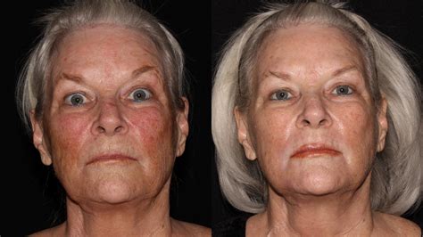 Halo Skin Rejuvenation Before And After Pictures Case Chico Yuba City Oroville CA