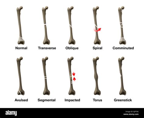 Different Kinds Of Fractures Vrogue