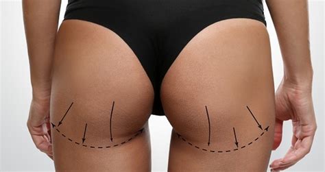 Gaining Weight Before A Brazilian Butt Lift Procedure Cosmos Aesthetics