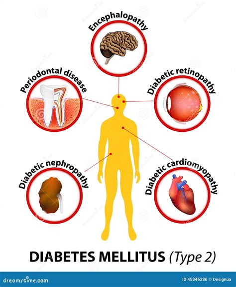 Diabetes Mellitus Long Term Complications Stock Vector Image 45346286