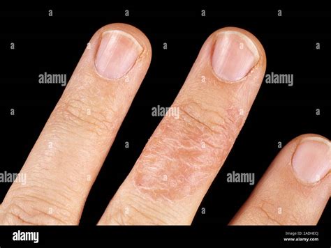 Contact Dermatitis View Of A Rash Lower Centre On A Finger Due To