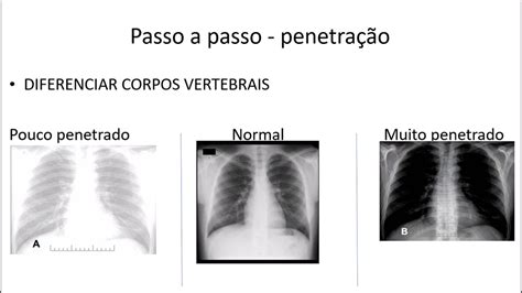 Curso de Radiografia de tórax Aula I Analisando radiografia de