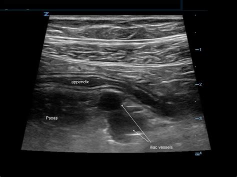 Appendicolith Ultrasound
