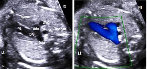Figure 10 From Technique Of Fetal Echocardiography Semantic Scholar