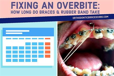How Long Do Braces Take To Fix An Overbite Orthodontic Braces Care