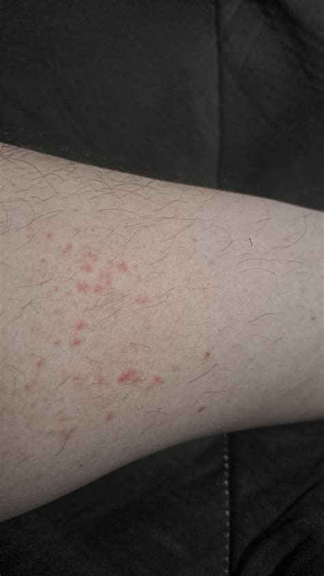 Is This A Rash Been On Inner Calf For A Month Rdermatologyquestions