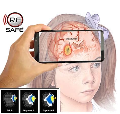 Brain Cancer And Tumors Cell Phone Radiation Study Rf Safe® Radio