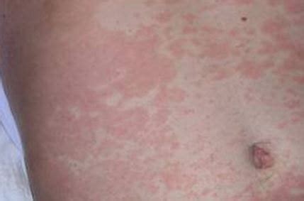 Cat skin diseases cat skin allergy cat skin irritation cat skin sores scabs on cats skin dog skin rashes pictures cat skin disorders cat skin cat skin problem stock image. Maculopapular Rash - Pictures, Causes, Treatment ...