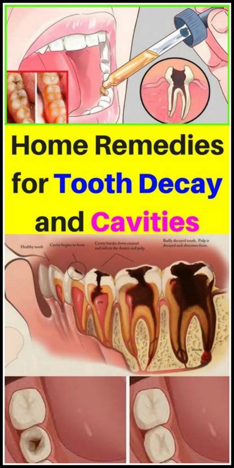 Home Remedies For Tooth Decay And Cavities Teeth Rotting Tooth