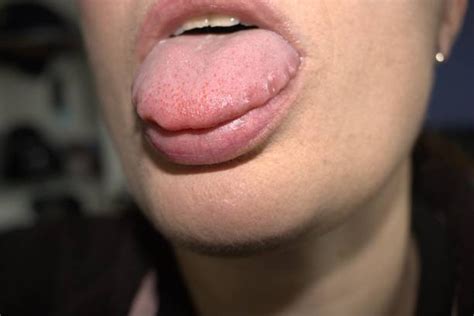 Fordyce Spots White Bumps On Lips Symptoms Causes Treatments