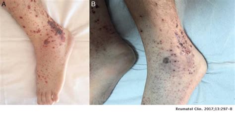 Leukocytoclastic Vasculitis And Infection Report Of A Case